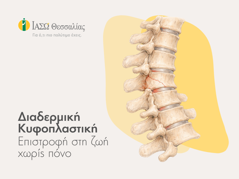 ΛΑΡΙΣΑ - ΙΑΣΩ Θεσσαλίας: ΔΙΑΔΕΡΜΙΚΗ ΚΥΦΟΠΛΑΣΤΙΚΗ- Λύση χωρίς ανοικτό χειρουργείο για το κάταγμα σπονδύλου (φωτο) ΛΑΡΙΣΑ - ΙΑΣΩ Θεσσαλίας: ΔΙΑΔΕΡΜΙΚΗ ΚΥΦΟΠΛΑΣΤΙΚΗ- Λύση χωρίς ανοικτό χειρουργείο για το κάταγμα σπονδύλου (φωτο)